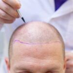 hair transplant in Turkey