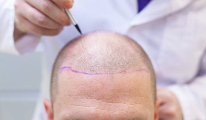 hair transplant in Turkey