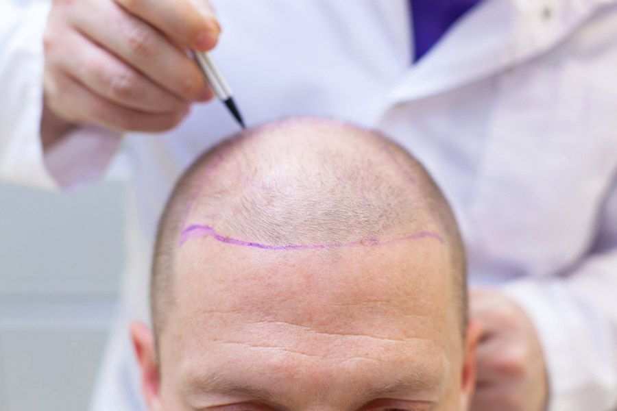 hair transplant in Turkey