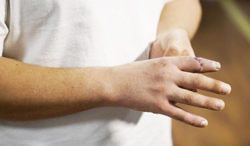 Turkey, operation to reimplant amputated finger