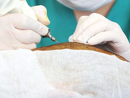 injerto capilar en Turquía, trasplante de pelo