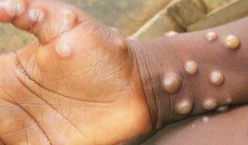 virus, monkeypox