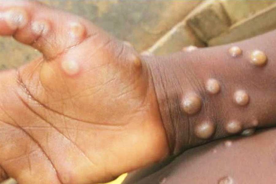 virus, monkeypox
