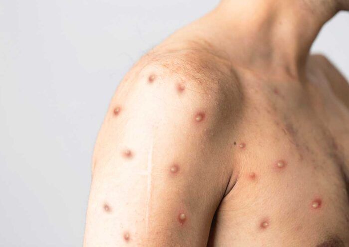 monkeypox virus