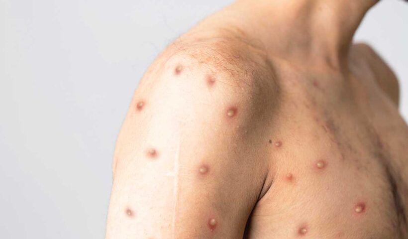 monkeypox virus