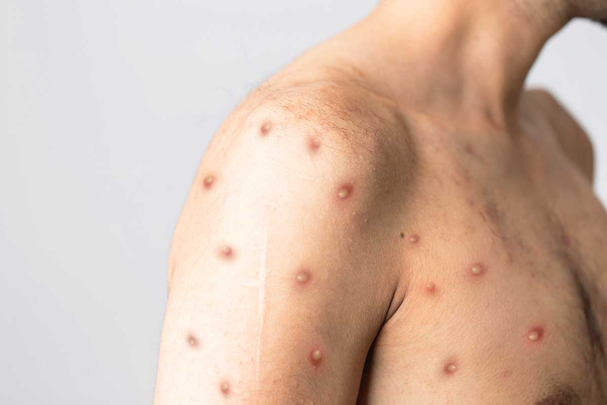 monkeypox virus