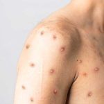 virus de la viruela del mono