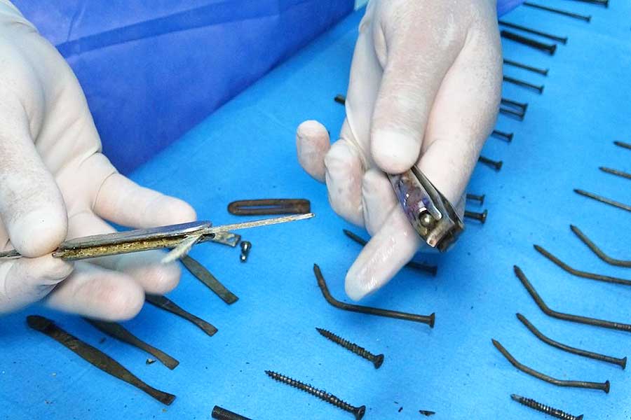 médicos turcos encuentran objetos en el estómago de una mujer