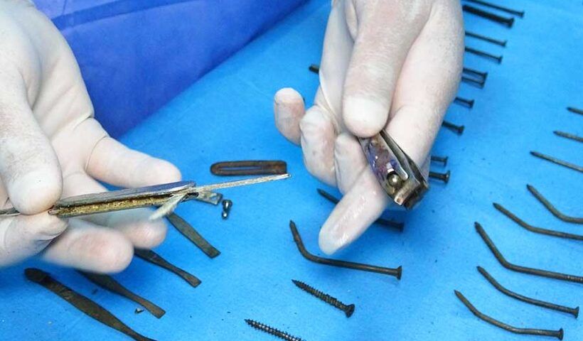 Turkish doctors find objects in woman's stomach