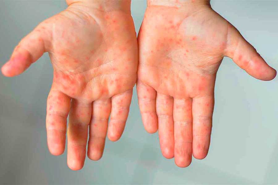 measles