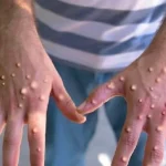 monkeypox, mpox