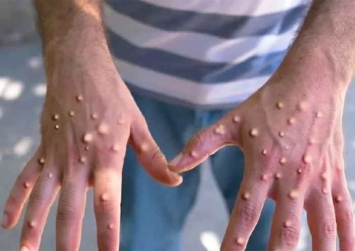 monkeypox, mpox