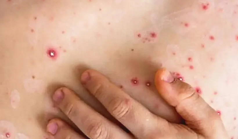 monkeypox-mpox