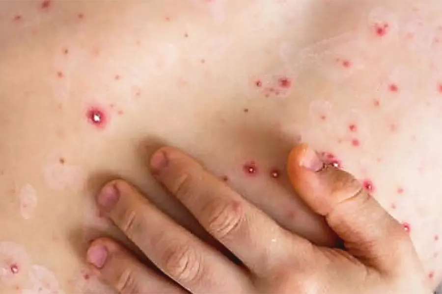 monkeypox-mpox