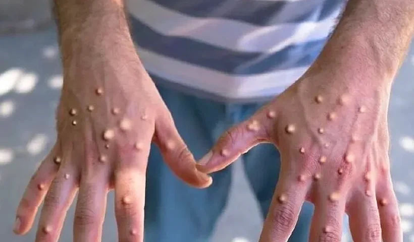 viruela del mono o símica (mpox)