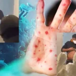 paciente con viruela del mono en Estambul