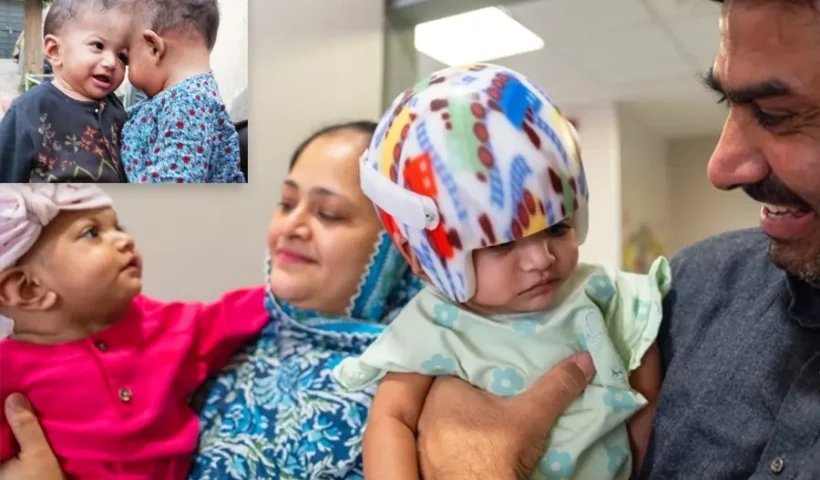 Siamese Twins separated in Turkey