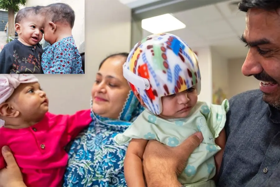 Siamese Twins separated in Turkey