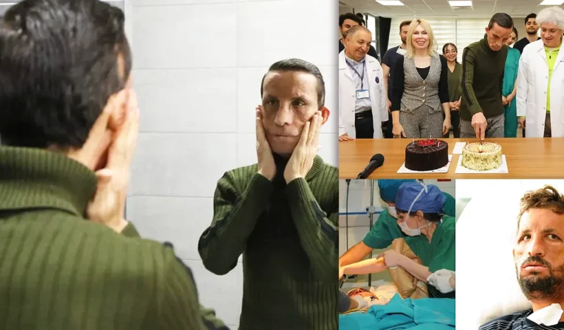 Uğur Acar, Turkey's first face transplant recipient, looks at his face in a mirror 14 years later.