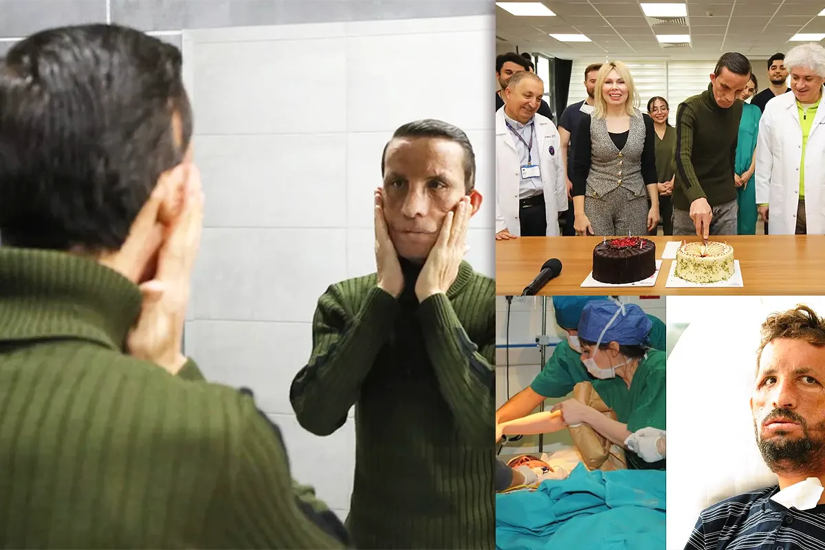 Uğur Acar, Turkey's first face transplant recipient, looks at his face in a mirror 14 years later.